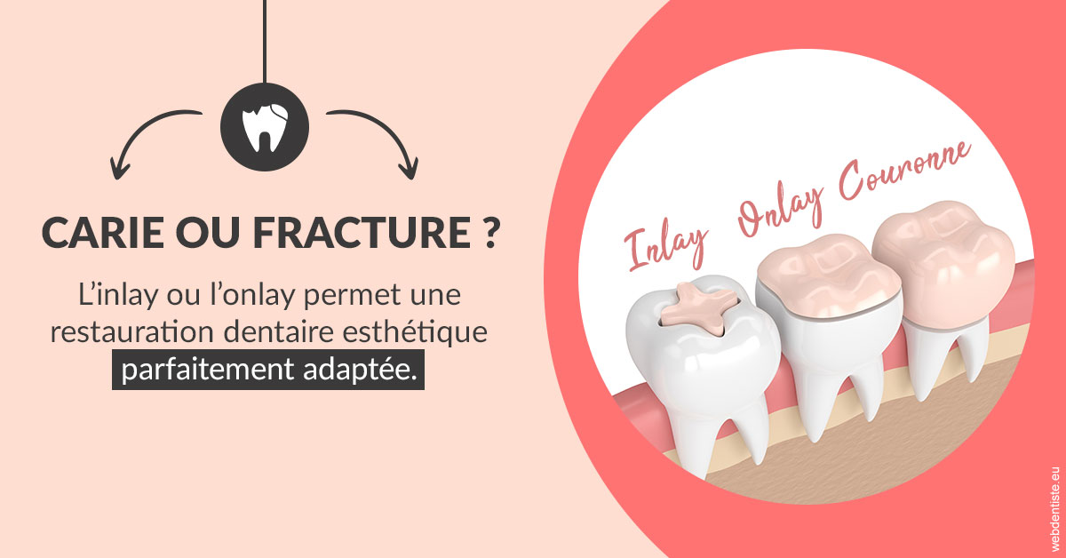 https://selarl-urpo.chirurgiens-dentistes.fr/T2 2023 - Carie ou fracture 2