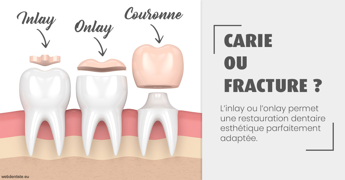 https://selarl-urpo.chirurgiens-dentistes.fr/T2 2023 - Carie ou fracture 1
