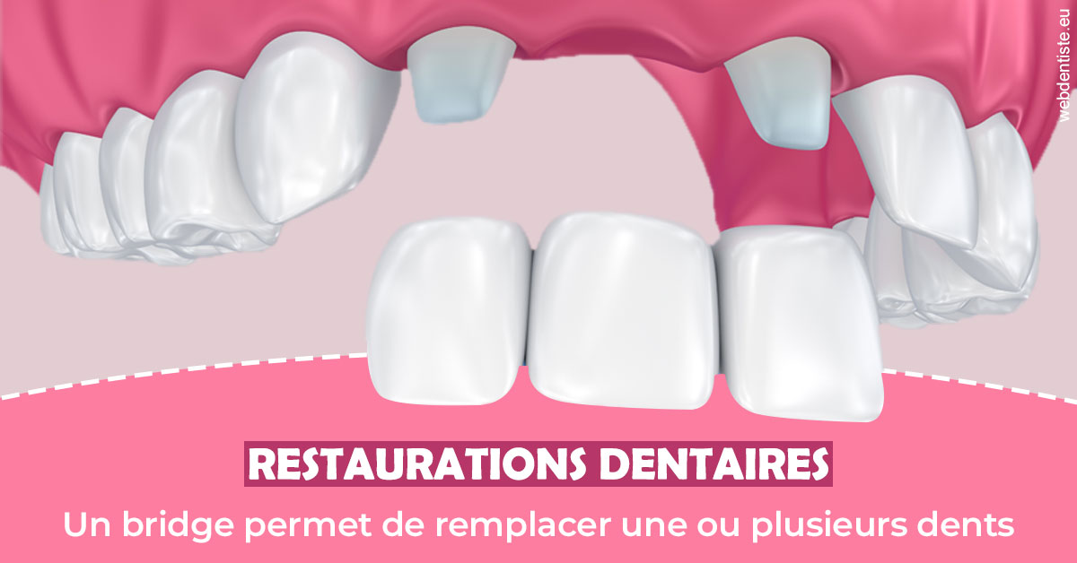 https://selarl-urpo.chirurgiens-dentistes.fr/Bridge remplacer dents 2