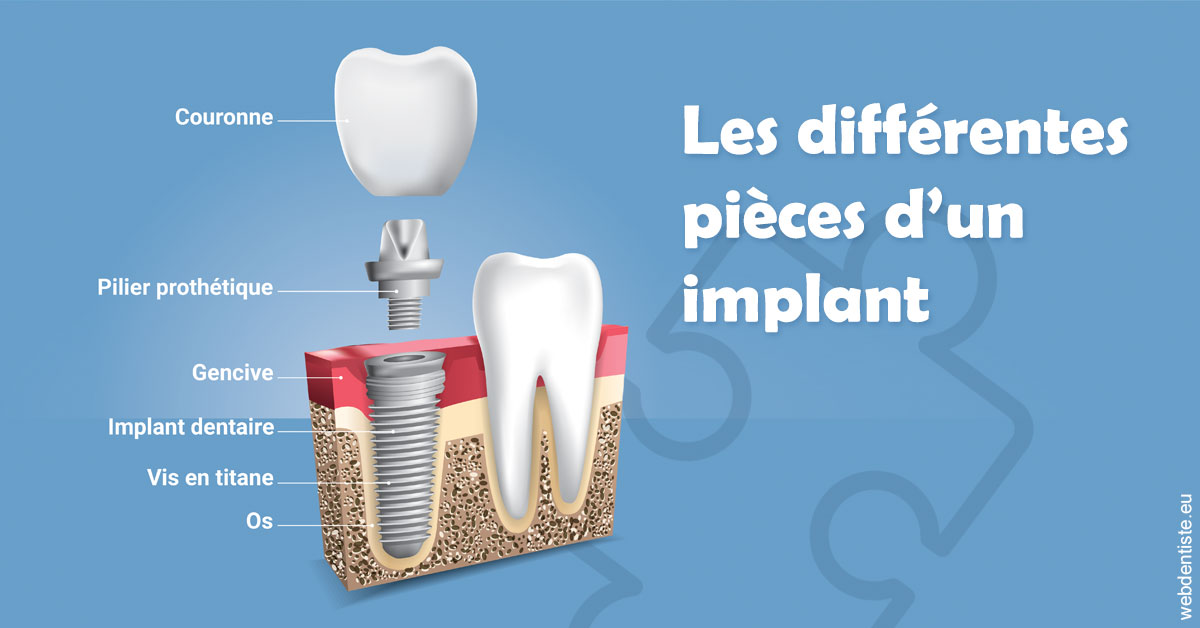 https://selarl-urpo.chirurgiens-dentistes.fr/Les différentes pièces d’un implant 1